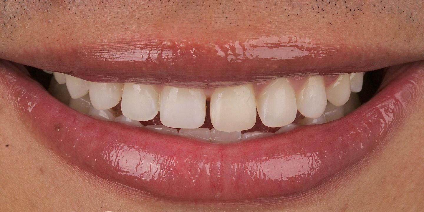 Antes: Resinas estratificadas
