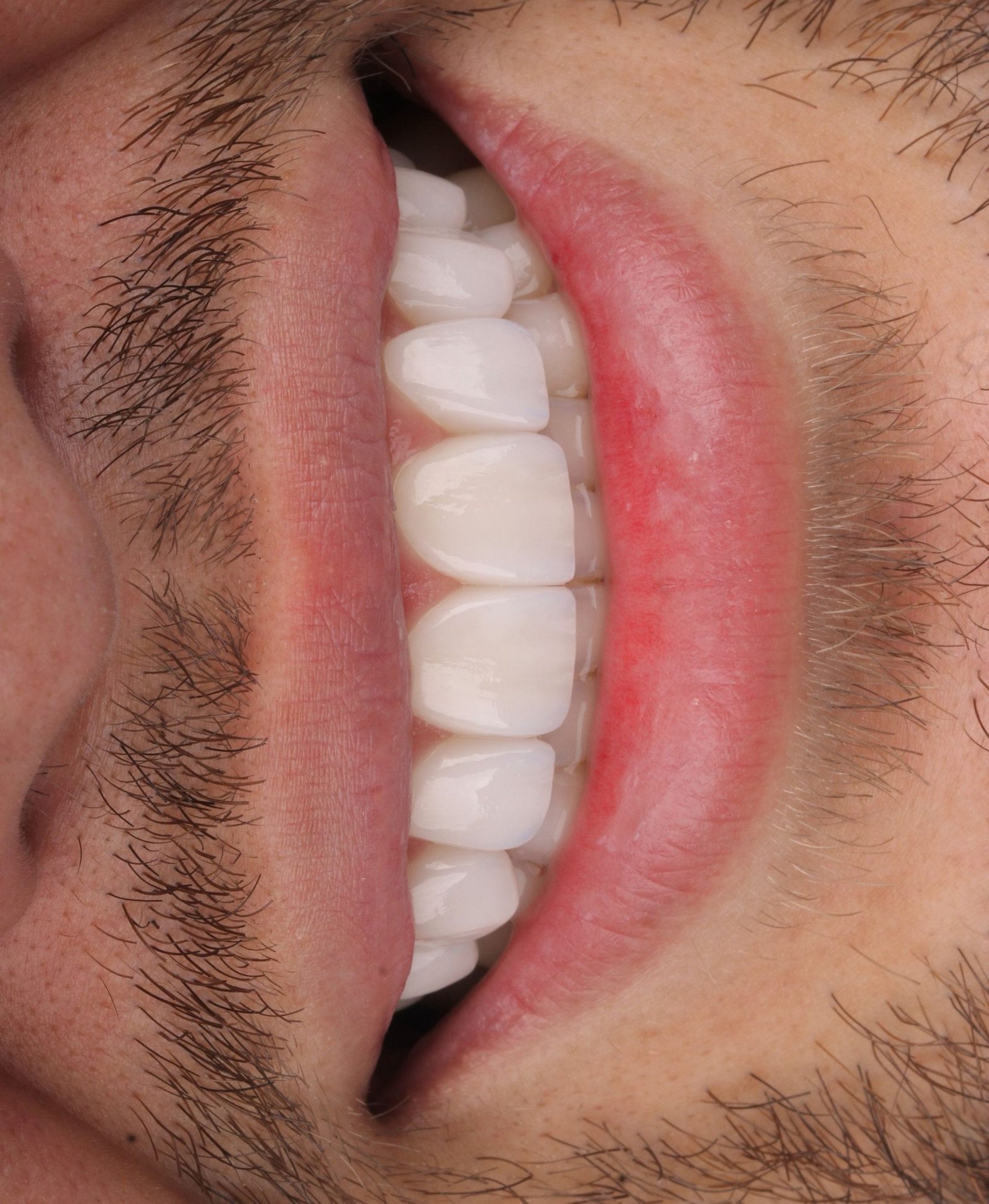 Después: Laminados en una sonrisa masculina