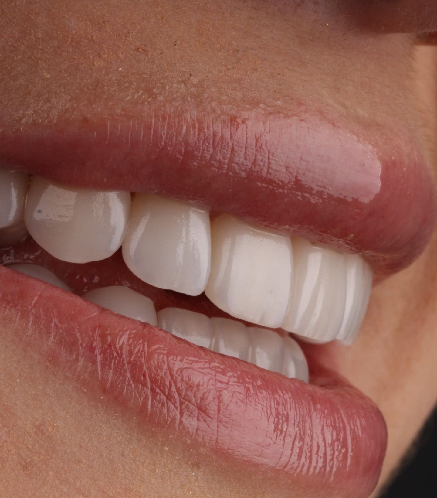 Sonrisa con laminados cerámicos, vista de tres cuartos